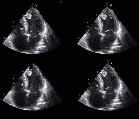 lv left ventricular mural thrombus without mi|left ventricular mural thrombus treatment.